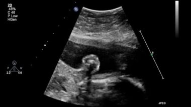 Fetal kalbin ultrason muayenesi.