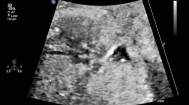 Fetal kalbin ultrason muayenesi.