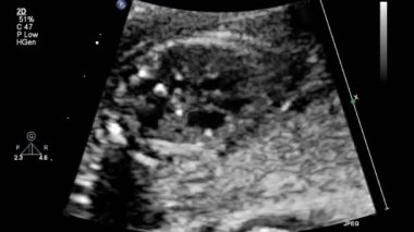 Fetal kalbin ultrason muayenesi.