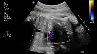 Fetal kalbin ultrason muayenesi.