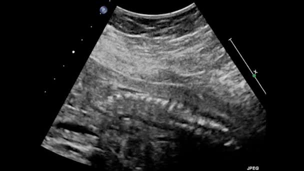 Ultrasound Examination Fetal Heart — Stock Video