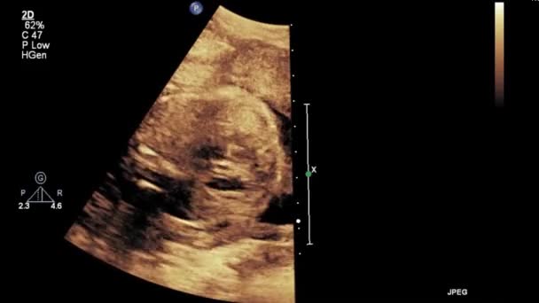 Ultrasound Examination Fetal Heart — Stock Video