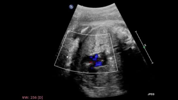 Exame Ultrassonográfico Coração Fetal — Vídeo de Stock