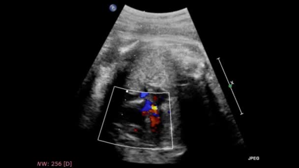 Ultrasound Memeriksa Jantung Janin — Stok Video