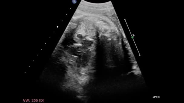 Ultrasound Examination Fetal Heart — Stock Video