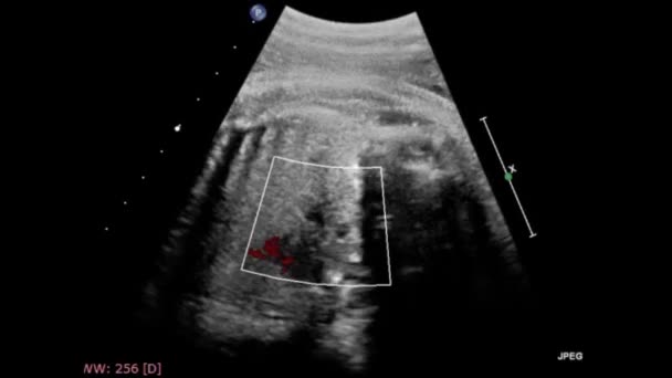 Ultraschalluntersuchung Des Fetalen Herzens — Stockvideo