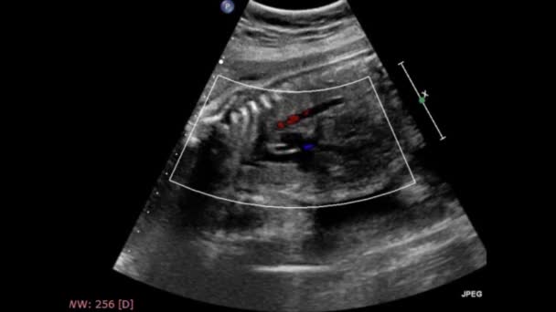 Υπερηχογραφική Εξέταση Της Εμβρυϊκής Καρδιάς — Αρχείο Βίντεο