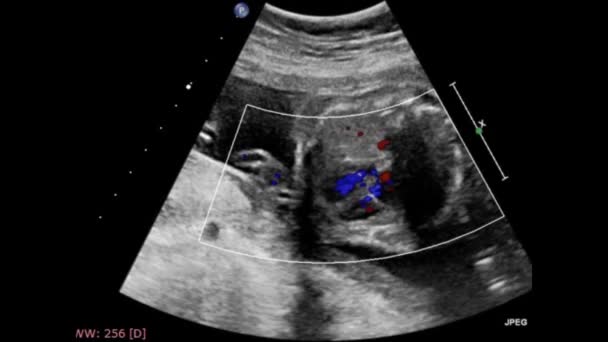 Ultraschalluntersuchung Des Fetalen Herzens — Stockvideo