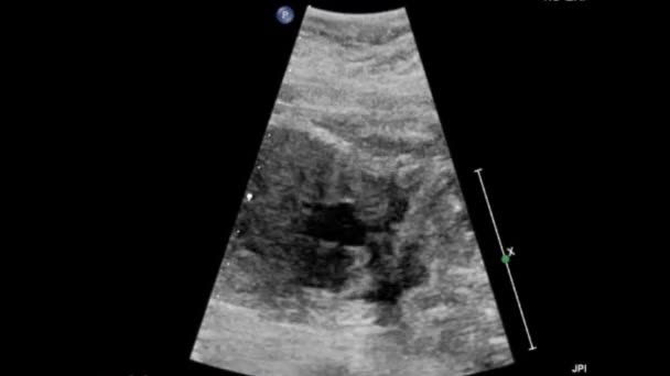 Ultrazvuková Prohlídka Fetalálního Srdce — Stock video
