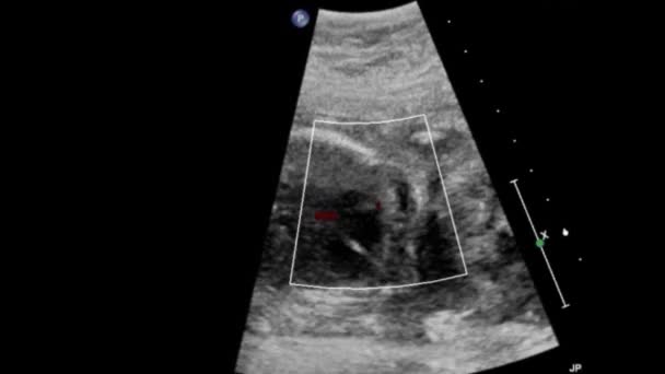 Ultraschalluntersuchung Des Fetalen Herzens — Stockvideo