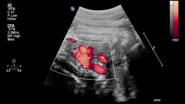 Badanie Ultrasonograficzne Serca Płodu — Wideo stockowe