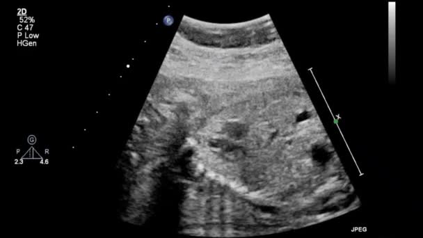 Exame Ultrassonográfico Coração Fetal — Vídeo de Stock