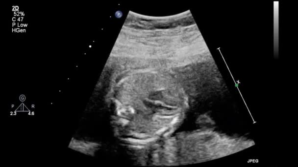 Ultrasound Examination Fetal Heart — Stock Video