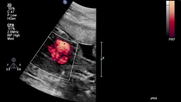 Exame Ultrassonográfico Coração Fetal — Vídeo de Stock