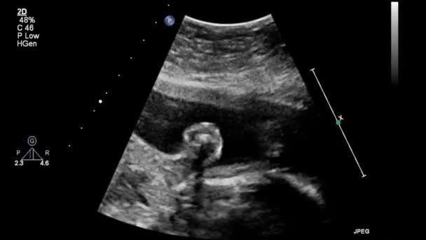 Ultrasound Examination Fetal Heart — Stock Video