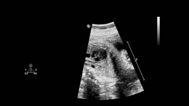 Fetal ekokardiyografi ile ultrasonografi ekranı.
