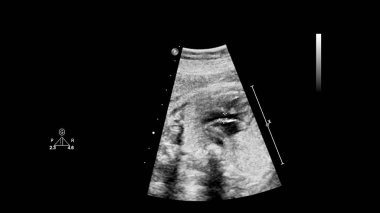 Fetal ekokardiyografi ile ultrasonografi ekranı.