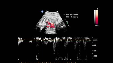 Fetal ekokardiyografi ile ultrasonografi ekranı.