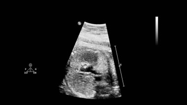 Fetal ekokardiyografi ile ultrasonografi ekranı.