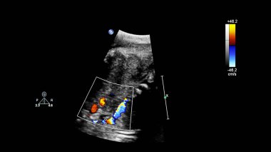 Fetal ekokardiyografi ile ultrasonografi ekranı.