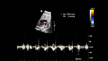 Fetal ekokardiyografi ile ultrasonografi ekranı.