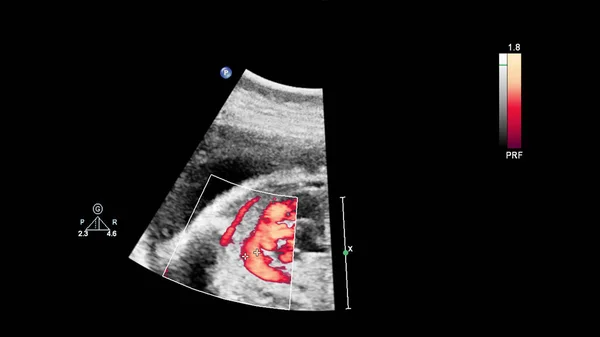 Ultrasound screen with fetal echocardiography. — Stock Photo, Image