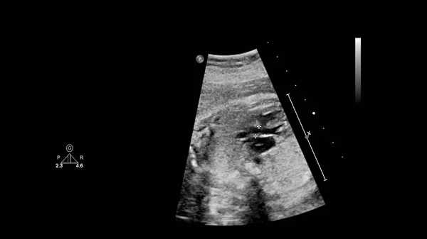 带胎儿超声心动图的超声屏幕. — 图库照片