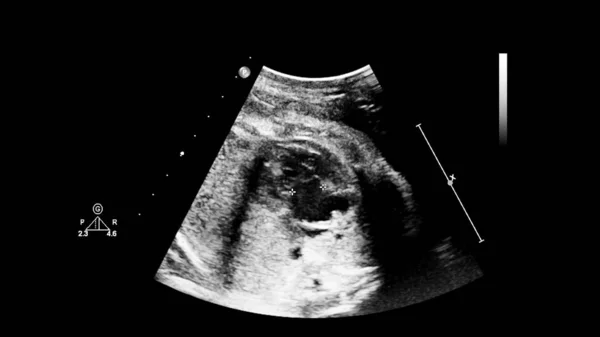 Ultrasound screen with fetal echocardiography. — Stock Photo, Image