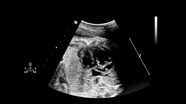 Ultrasound screen with fetal echocardiography. — Stock Photo, Image