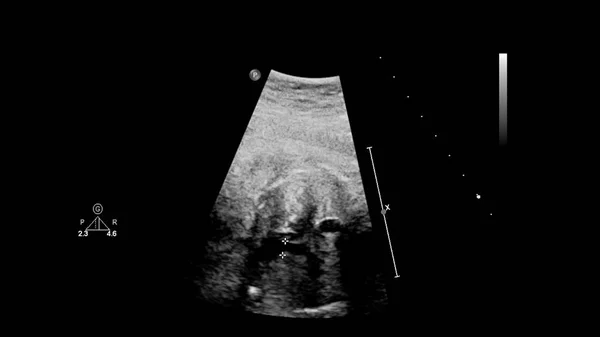 Ecrã ultrassonográfico com ecocardiografia fetal . — Fotografia de Stock