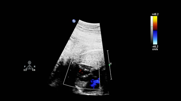 Ultrasound screen with fetal echocardiography. — Stock Photo, Image