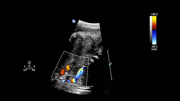 Ecrã ultrassonográfico com ecocardiografia fetal . — Fotografia de Stock