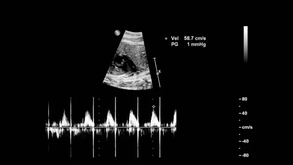 Ultrahang képernyő magzati echokardiográfia. — Stock Fotó