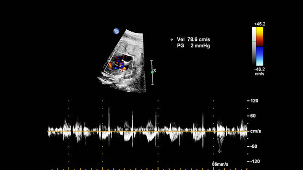 УЗИ с эхокардиографией плода
.