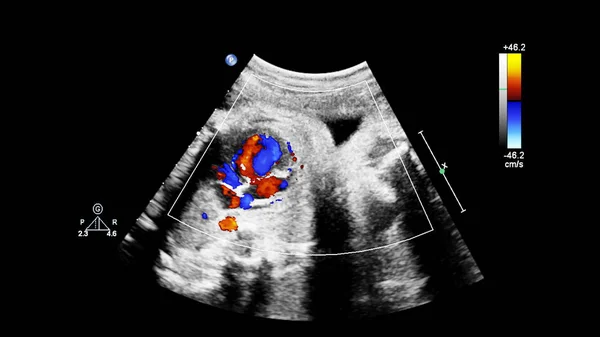 Ecrã ultrassonográfico com ecocardiografia fetal . — Fotografia de Stock