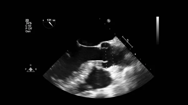 Изображение Сердца Сером Режиме Время Трансофагеального Ультразвука — стоковое фото