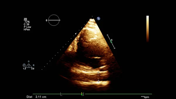 Afbeelding Van Het Hart Grijs Schaal Modus Tijdens Transesofageale Echografie — Stockfoto