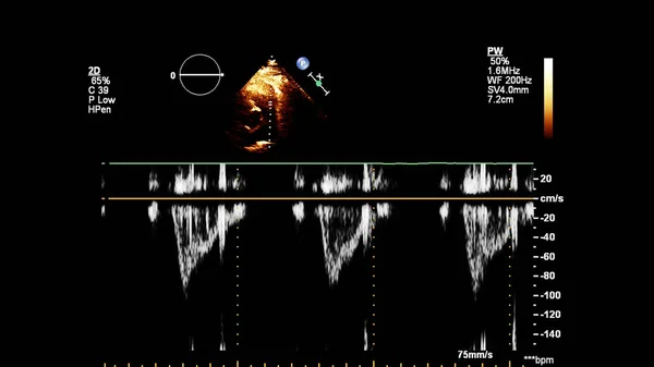 Image of the heart in gray-scale mode during transesophageal ultrasound.