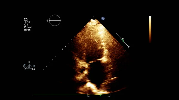 Bild Hjärtat Gråskala Transesofagalt Ultraljud — Stockfoto