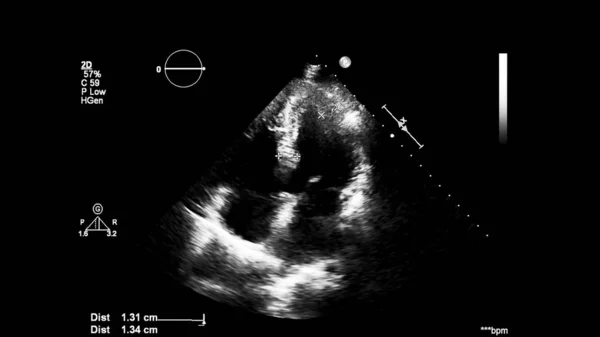 经食管超声下灰度型心脏影像学 — 图库照片