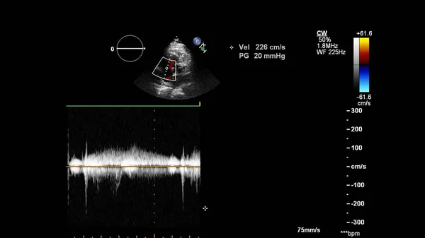Изображение Сердца Время Трансофагеального Ультразвука Доплеровским Режимом — стоковое фото