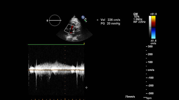 Image of the heart during transesophageal ultrasound with Doppler mode.