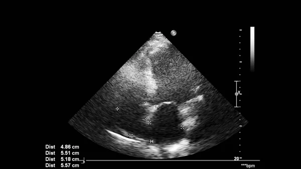 Image of the heart in gray-scale mode during transesophageal ultrasound.