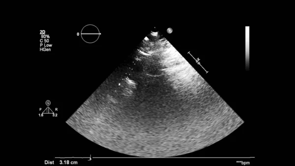 Transesofageal Ultrason Sırasında Kalbin Gri Ölçekli Görüntüsü — Stok fotoğraf