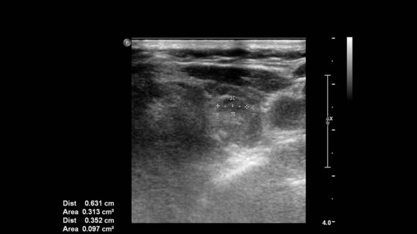 УЗИ кровеносных сосудов в режиме серой шкалы
.
