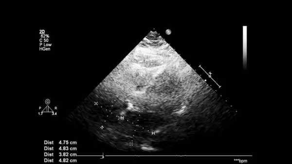 Image of the heart in gray-scale mode during transesophageal ultrasound.