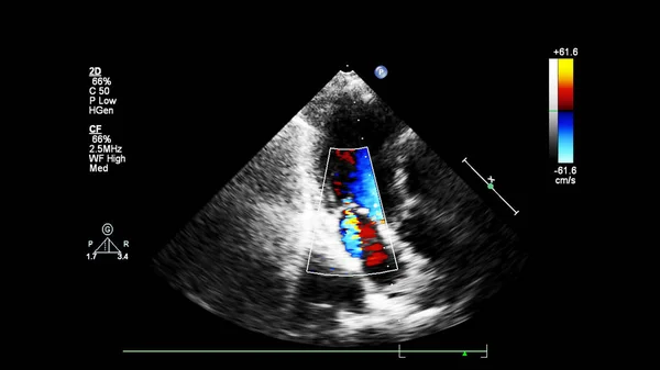 Beeld Van Het Hart Tijdens Transesofageale Echografie Met Doppler Modus — Stockfoto