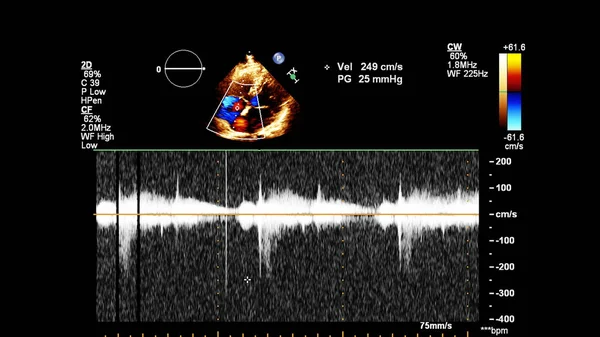 Imagem Coração Durante Ultrassom Transesofágico Com Modo Doppler — Fotografia de Stock