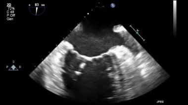 Transesophageal ultrasound video in gray-scale mode.
