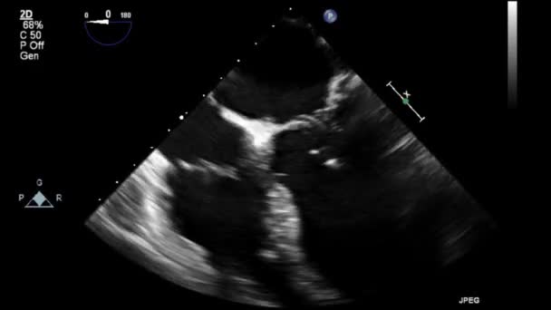 Transesophageal Ultrasound Video Gray Scale Mode — Stock Video
